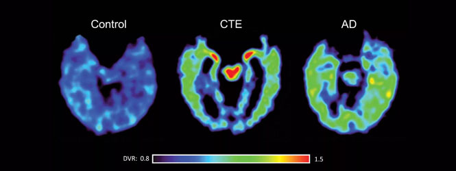 CTE vs. Alzheimer's